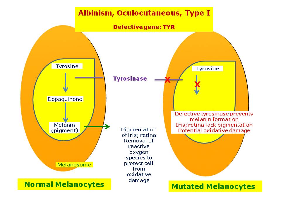 Albinism Oculocutaneous Type I Hereditary Ocular Diseases albinism-oculocutaneous-type-i-hereditary-ocular-diseases